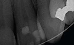 Intraorale röntgenopname gebitselement 21