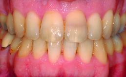 Intraorale opname einde orthodontische behandeling