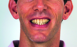 Extraorale opname einde orthodontische behandeling