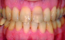 Intraorale opname patiënt einde orthodontische behandeling