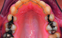 Intraorale opname maxilla einde orthodontische behandeling