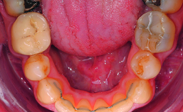 Intraorale opname mandibula einde orthodontische behandeling