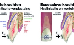 Orthodontische verplaatsing, hyalinisatie en wortelresorptie