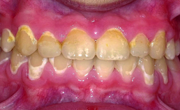 Wittevleklaesies na verwijdering vaste orthodontische apparatuur