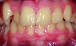 Intraoraal beeld voor de orthodontische behandeling