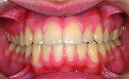 Frontaal aanzicht direct na actieve orthodontische behandeling