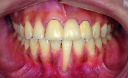 X-effect 10 jaar na actieve orthodontische behandeling