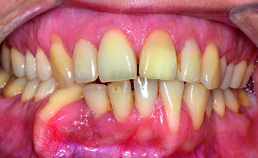 Substantiële tandstandverandering 