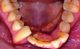 Parodontium- en botverlies door tandstandverandering