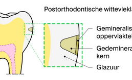 Schematische weergave postorthodontische wittevleklaesie