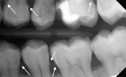 Beeld tandsteen op een bitewing-röntgenopname