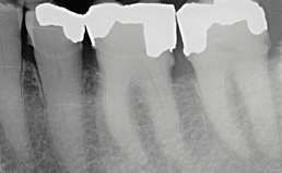 Intraorale röntgenopname met restauraties op tandsteen