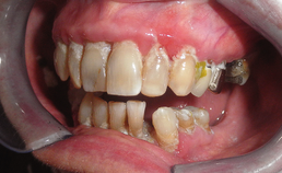 Slechte mondgezondheid en parodontale problematiek