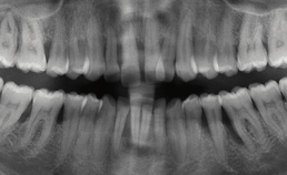 Gegeneraliseerde parodontitis bij intake