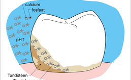 Calcium- en fosfaationen slaan neer en vormen tandsteen