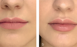 Fillerbehandeling van de lippen