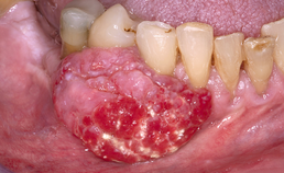 Dentinogene ghost cell-tumor: zwelling