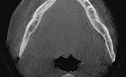 CBCT na verwijdering ghost cell-tumor