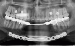 Panoramische röntgenopname na tweede reconstructie mandibula