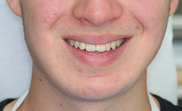 Extraoraal beeld na reconstructie mandibula