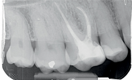 Röntgenopname van de zijdelingse delen na endodontische behandeling