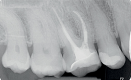 Morfologie van molaren is hersteld