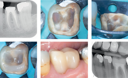 Preparatie endodontisch behandeld gebitselement