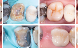 Endodontische behandeling bij patiënt met bruxisme