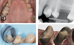  indicatie  na endodontische behandeling voor indirecte restauraties 