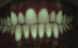 Rood-fluorescent tandplaquebeeld weinig plaqueophoping