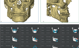 Postoperatief 3D-beeld van frontaal en lateraal aangezicht