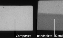 T-WIM microradiografische opname composietrestauratie