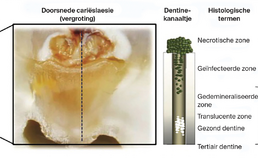 Diagram gecaviteerde carieuze dentinelaesie