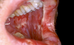 Orale mucositis