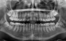  Klachtenvrije derde molaren, panoramische röntgenopname