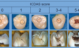 De ICDAS-score