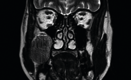 MRI met coronaal aanzicht