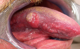 Plaveiselcelcarcinoom van de tong