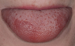 Chronic lingual papulosis