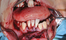 verwonding onderlip en dentaal letsen onderfront