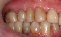 Behandelresultaat rechts na orthodontie