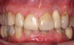 Frontaal aanzicht na orthodontische behandeling 