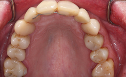 Behandelresultaat boven na orthodontie