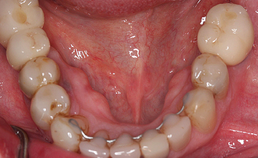 Behandelresultaat onder na orthodontie