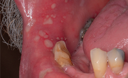Multipele ulcera door  een herpes zoster