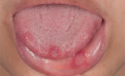 Afteuze ulcera (minor type)