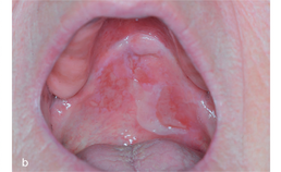Mucosale afwijkingen bij slijmvliespemfigoïd