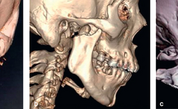 Locatie van fracturen van het collum mandibulae