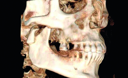 CBCT van verticaal hoogteverlies van de ramus mandibulae