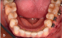 Behandeling fractuur collum mandibulae